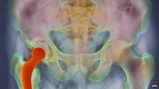 X-ray of hip replacement