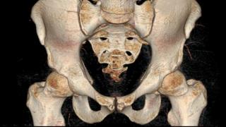 Pelvis