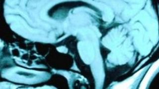 Sgan MRI o'r ymennydd
