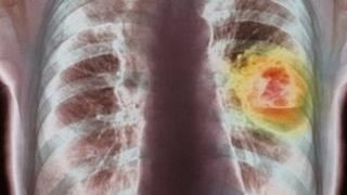 Lung cancer X-ray