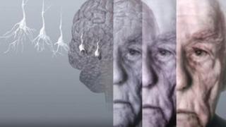 Artist's image showing the brain of an elderly man with dementia