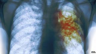 TB in a patient's lung