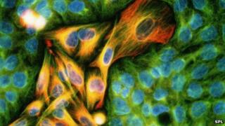 Skin cancer cells