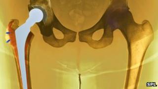 Hip replacement X-ray
