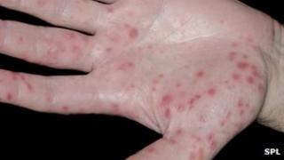 Infected hand