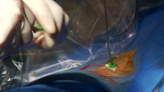 A treatment called renal denervation