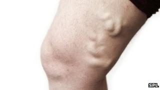 Varicose vein
