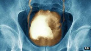 Bladder infected with cancer
