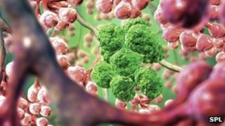 lung cancer