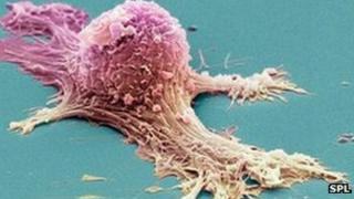 Ovarian cancer