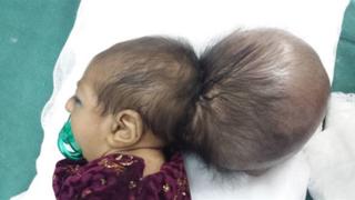 Asree Gul before the operation