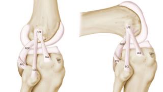 Anatomical sketch of ligaments of the knee