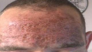 Victim's forehead after acid attack