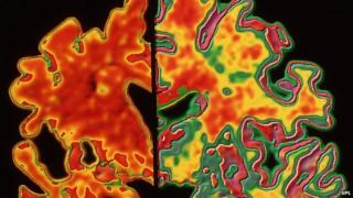 Alzheimer's brain (left) compared with healthy brain (right)