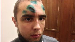 Mikhailo Niskoguz shows his injuries, which he says were inflicted by riot police. Cuts and bruises have been covered with a green antiseptic.