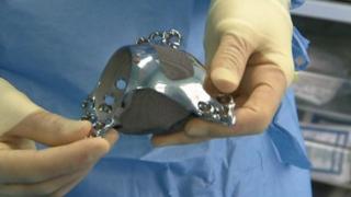 3D printed hip joint