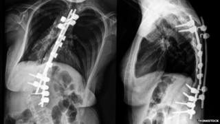 Scoliosis X-Ray. Pic: Thinkstock