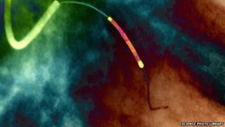 Coloured X-ray angiogram of a balloon catheter and stent