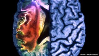 MRI scan of stroke