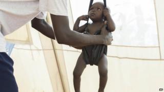 A child with suspected malnutrition is weighed at IMC nutrition program clinic in Malakal, South Sudan (25 July 2014)