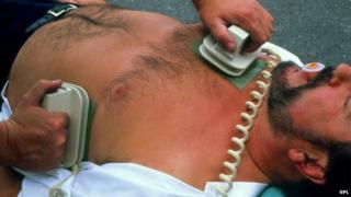 Picture of defibrillation after cardiac arrest