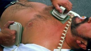 Picture of defibrillation after cardiac arrest