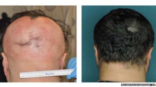 Alopecia can lead to patchy or complete hair-loss