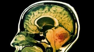 Lesion indicating medulloblastoma