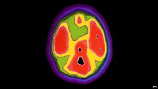 Сканирование мозга четырехлетнего ребенка с аутизмом