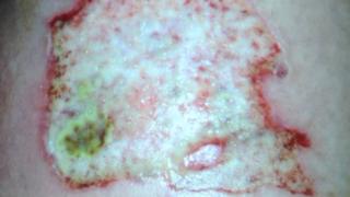 Nail glue burn
