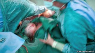 A caesarean section