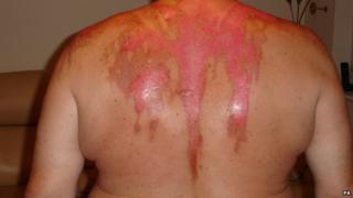 Ken Gregory's scars after scalding water attack