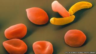 The parasite Plasmodium falciparum (in yellow) among red blood cells