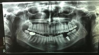X-ray of Lizzie Porter's teeth