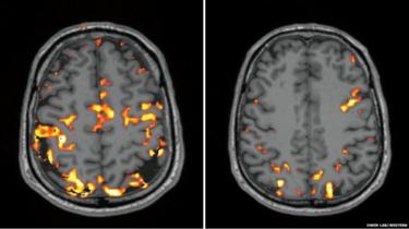 hersenscans