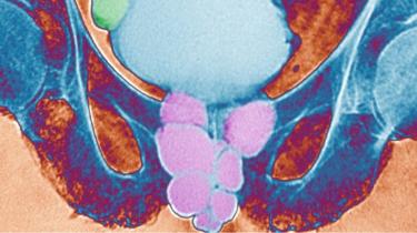 Radiografía de la cavidad prostática y la pelvis