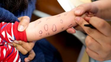 Un bambino in fase di test per diverse allergie