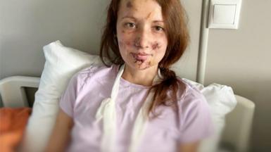 Ekaterina Volkova with cuts on her face in hospital