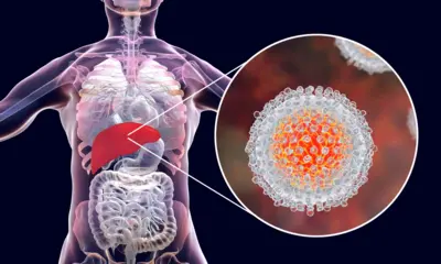  Ilustração mostra o fígado e uma visão aproximada dos vírus da hepatite C