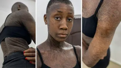 lamellar ichthyosis na situation wia pesin get dry skin, wey get scales and e dey crack