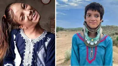 How one kind Indian doctor correct neck wey bend and save teenager life