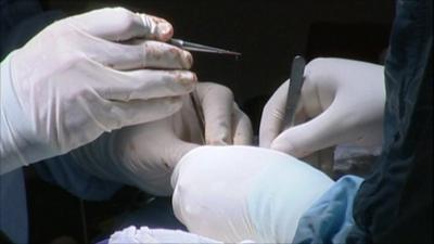 Surgeons perform stroke surgery