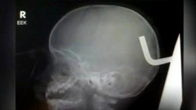 X-ray showing metal hook in Jessiah Jackson's skull