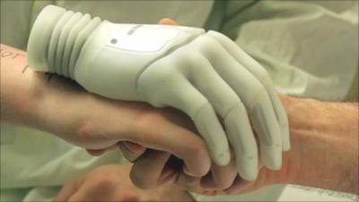 Milo being fitted for a bionic hand