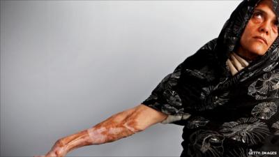 A woman in Herat shows her arm, covered in scars from burns she inflicted on herself a decade ago