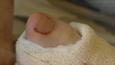 A big toe for a thumb