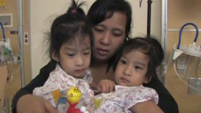 Two-year-old conjoined twins Angelina and Angelica Sabuco, before separation operation