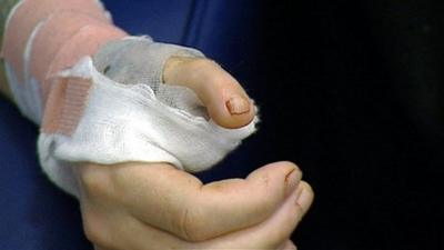 Man's hand with a toe in place of a thumb