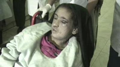 Fifteen-year-old Sahar Gul in a wheel chair with black eyes and scars on her face.