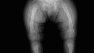 X-ray of child with rickets